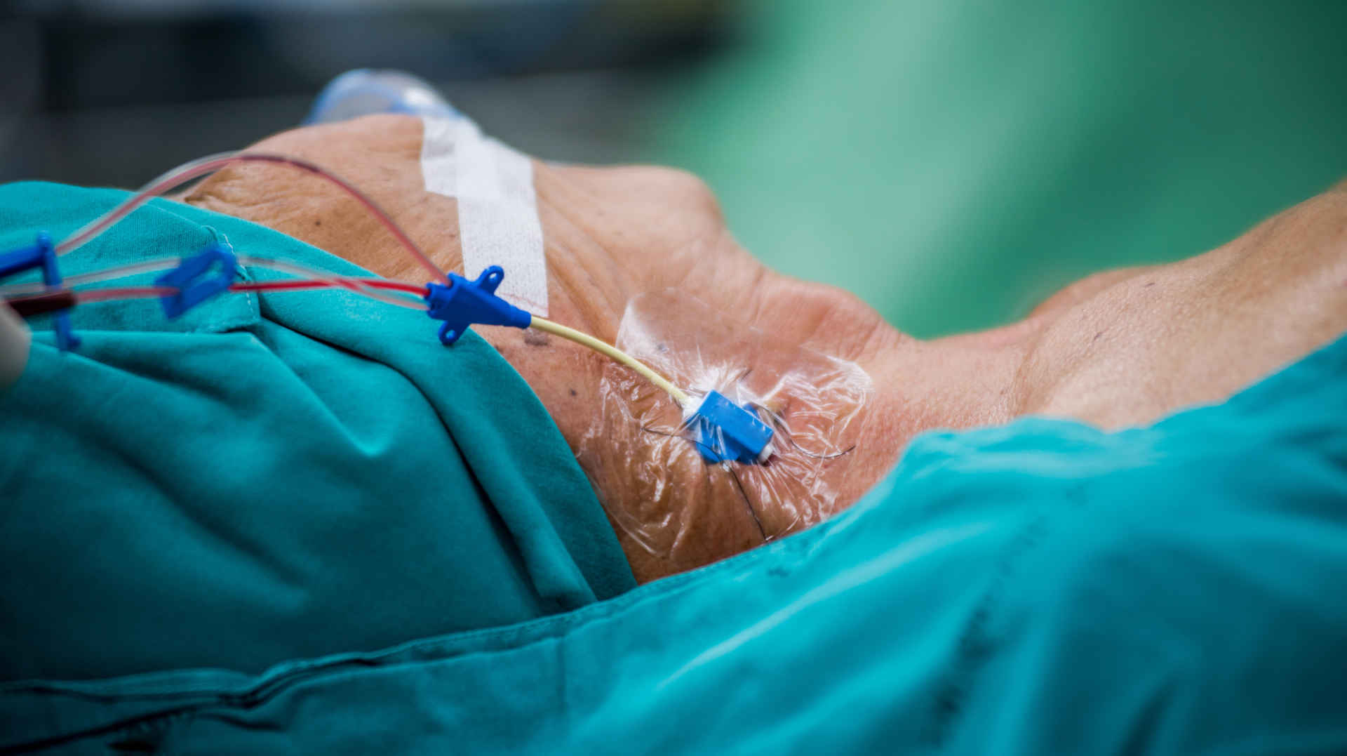 Right internal juglar central venous catheter