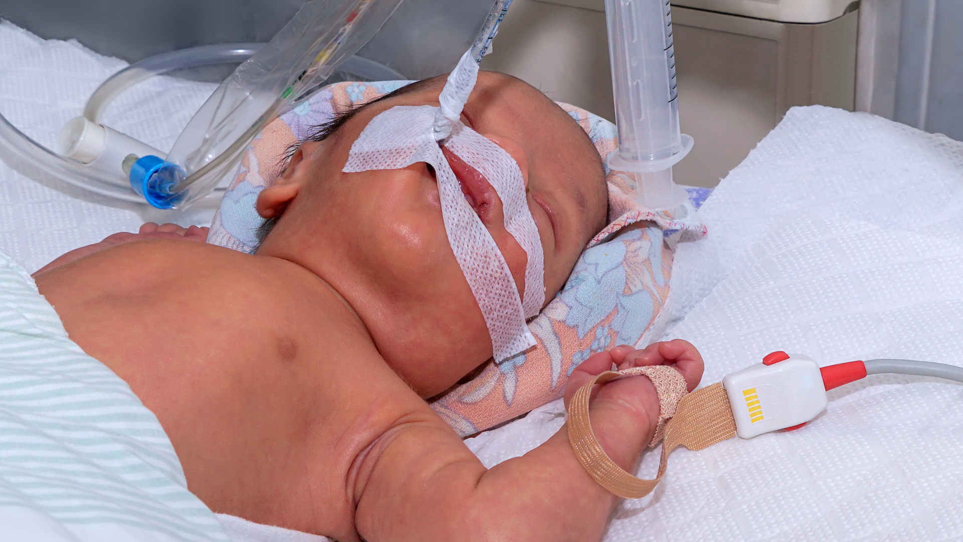 Neonate intubated in the NICU